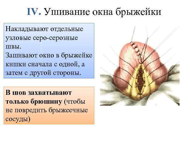IV. Ушивание окна брыжейки Накладывают отдельные узловые серо-серозные швы. Зашивают окно в брыжейке кишки
