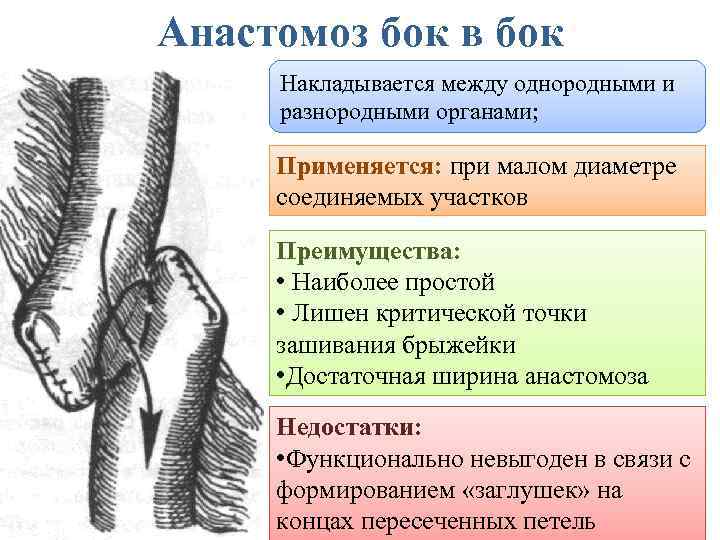 Анастомоз бок в бок Накладывается между однородными и разнородными органами; Применяется: при малом диаметре