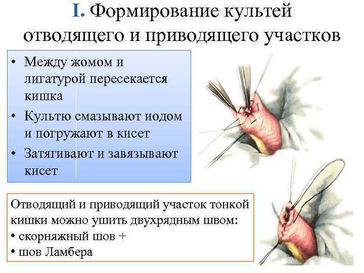 I. Формирование культей отводящего и приводящего участков • Между жомом и лигатурой пересекается кишка