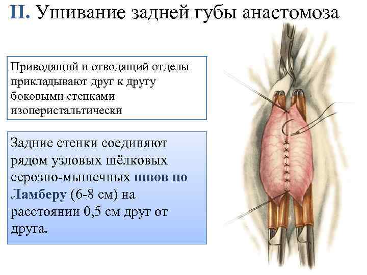 II. Ушивание задней губы анастомоза Приводящий и отводящий отделы прикладывают друг к другу боковыми