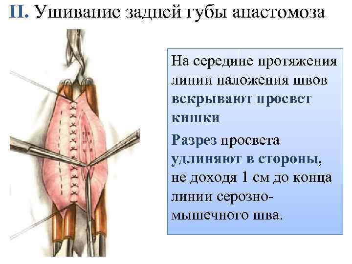 II. Ушивание задней губы анастомоза На середине протяжения линии наложения швов вскрывают просвет кишки