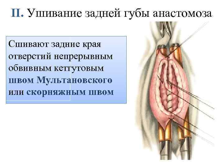 II. Ушивание задней губы анастомоза Сшивают задние края отверстий непрерывным обвивным кетгутовым швом Мультановского