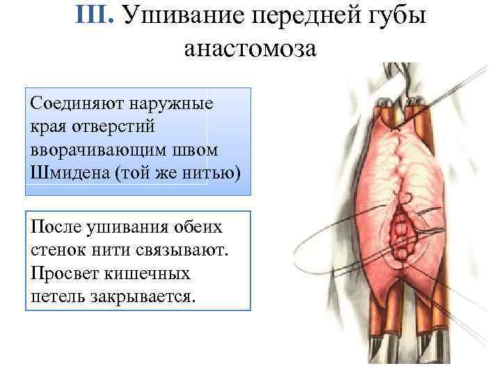 III. Ушивание передней губы анастомоза Соединяют наружные края отверстий вворачивающим швом Шмидена (той же