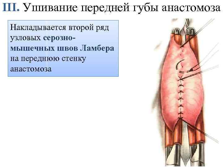 III. Ушивание передней губы анастомоза Накладывается второй ряд узловых серозномышечных швов Ламбера на переднюю