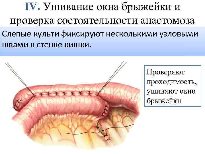 IV. Ушивание окна брыжейки и проверка состоятельности анастомоза Слепые культи фиксируют несколькими узловыми швами