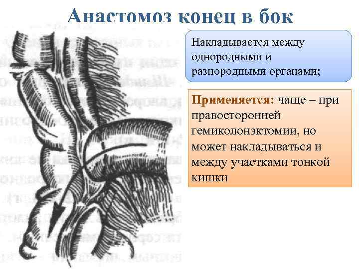 Кавакавальные анастомозы и портокавальные схема