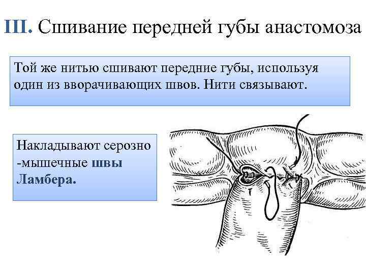 III. Сшивание передней губы анастомоза Той же нитью сшивают передние губы, используя один из