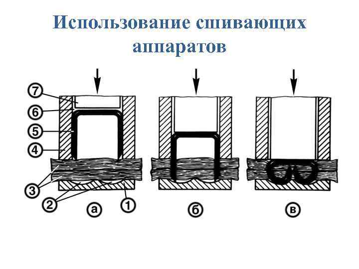 Использование сшивающих аппаратов 