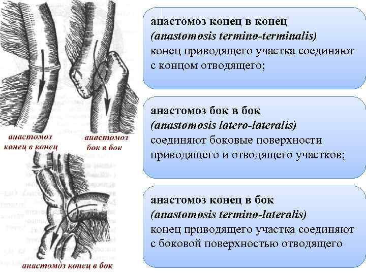 Анастомоз по брауну схема