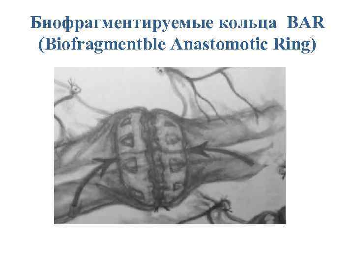 Биофрагментируемые кольца BAR (Biofragmentble Anastomotic Ring) 
