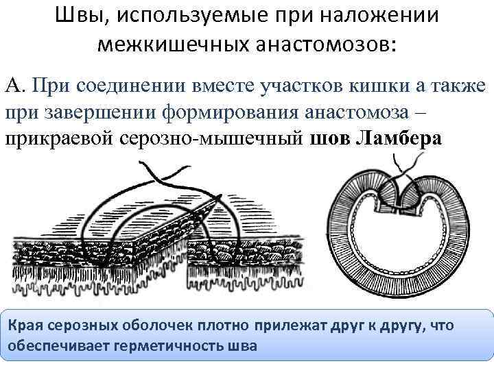Швы, используемые при наложении межкишечных анастомозов: А. При соединении вместе участков кишки а также