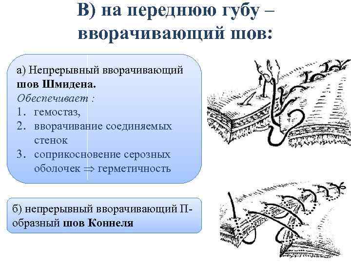 Вворачивающий сквозной шов через все слои кишечной стенки называют