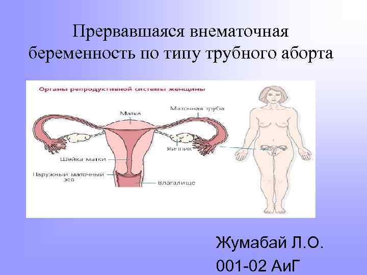 Прервавшаяся внематочная беременность по типу трубного аборта Жумабай Л. О. 001 -02 Аи. Г