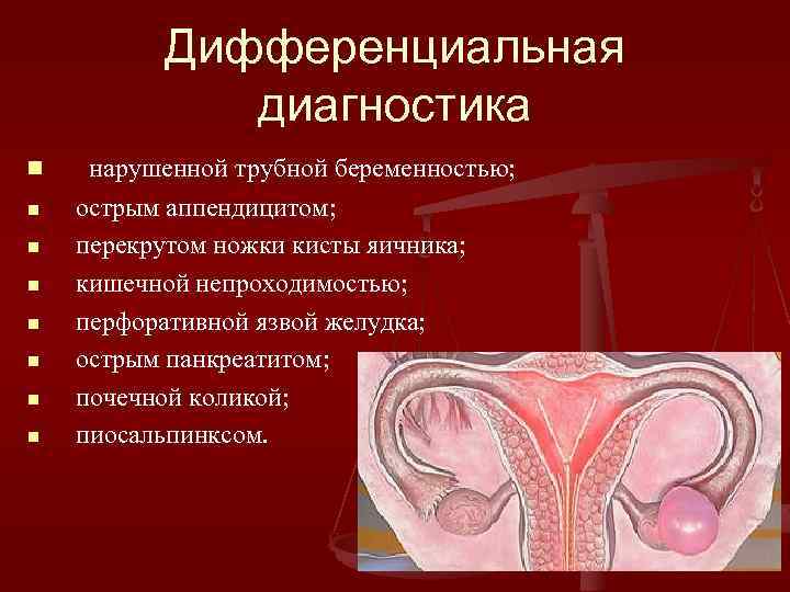 Дифференциальная диагностика n n n n нарушенной трубной беременностью; острым аппендицитом; перекрутом ножки кисты