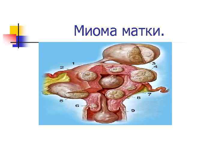 Миома матки. 