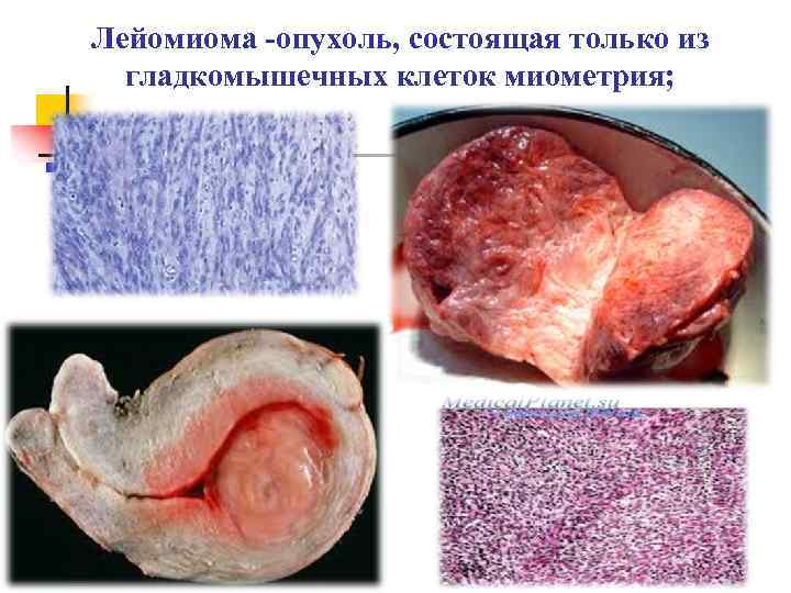Лейомиома -опухоль, состоящая только из гладкомышечных клеток миометрия; 