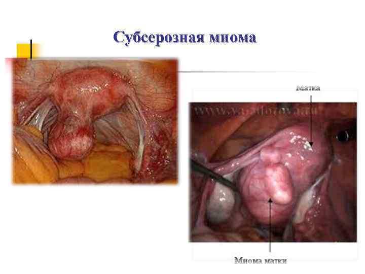 Субсерозная миома 