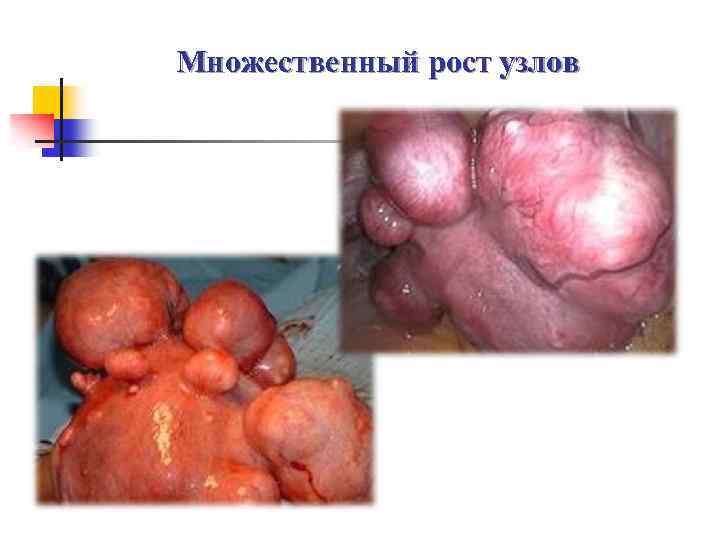 Множественный рост узлов 