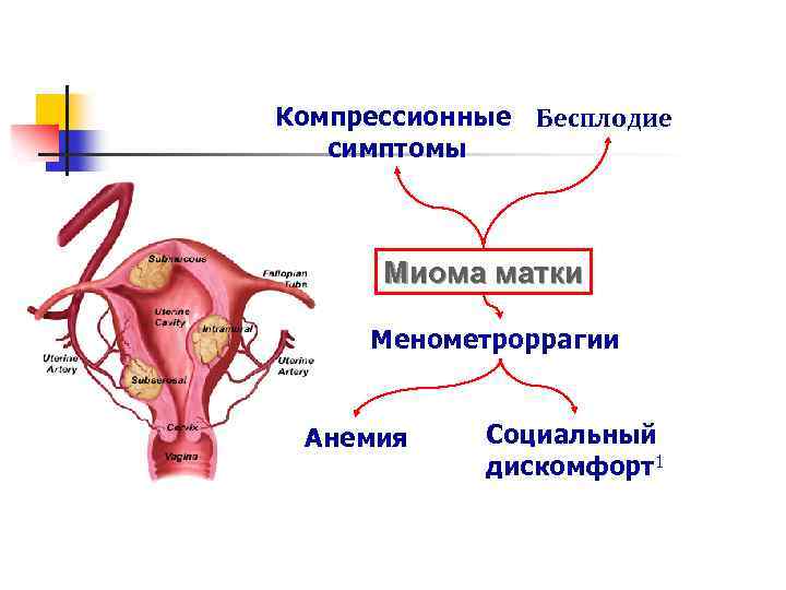 Миома матки, клиника Компрессионные Бесплодие симптомы Миома матки Менометроррагии Анемия Социальный дискомфорт1 
