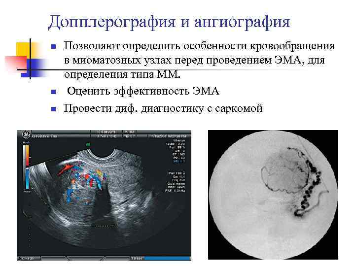 Допплерография и ангиография n n n Позволяют определить особенности кровообращения в миоматозных узлах перед