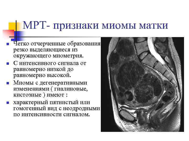 МРТ- признаки миомы матки n n Четко отчерченные образования, резко выделяющиеся из окружающего миометрия.