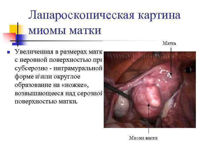 Лапароскопическая картина миомы матки n Увеличенная в размерах матка с неровной поверхностью при субсерозно