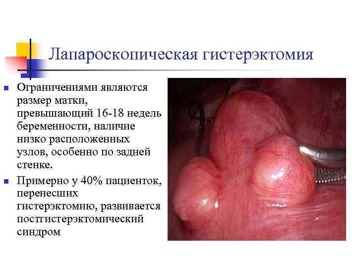 Лапароскопическая гистерэктомия n n Ограничениями являются размер матки, превышающий 16 -18 недель беременности, наличие