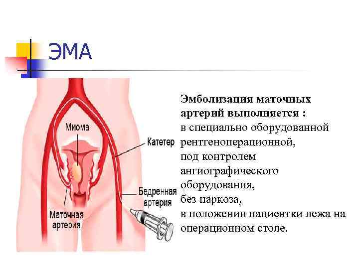 ЭМА Эмболизация маточных артерий выполняется : в специально оборудованной рентгеноперационной, под контролем ангиографического оборудования,
