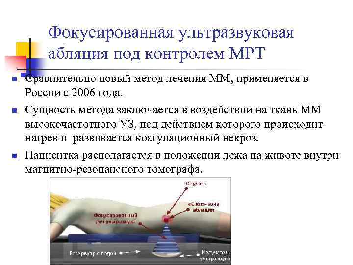 Фокусированная ультразвуковая абляция под контролем МРТ n n n Сравнительно новый метод лечения ММ,