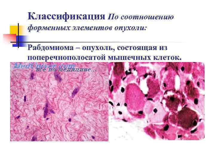 Классификация По соотношению форменных элементов опухоли: Рабдомиома – опухоль, состоящая из поперечнополосатой мышечных клеток.