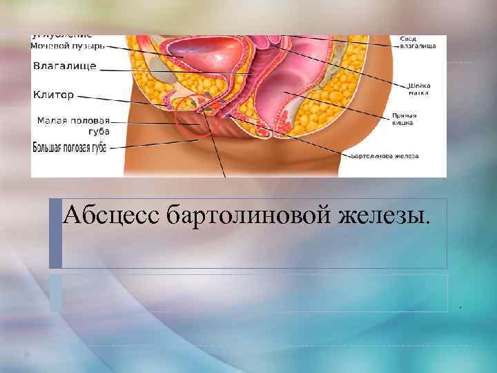 Абсцесс бартолиновой железы. . 