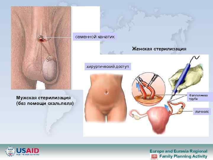 семенной канатик Женская стерилизация хирургический доступ Мужская стерилизация (без помощи скальпеля) Фаллопиева труба яичник