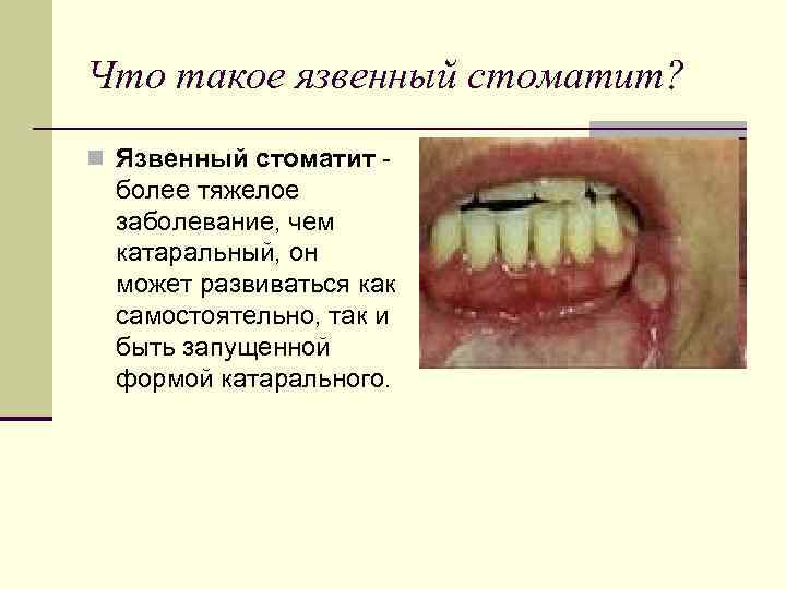 Что такое язвенный стоматит? n Язвенный стоматит - более тяжелое заболевание, чем катаральный, он