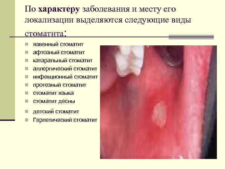 По характеру заболевания и месту его локализации выделяются следующие виды стоматита: n язвенный стоматит