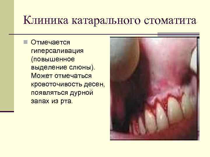 Клиника катарального стоматита n Отмечается гиперсаливация (повышенное выделение слюны). Может отмечаться кровоточивость десен, появляться