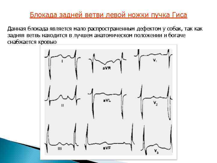 Блокада задней ветви левой ножки пучка Гиса Данная блокада является мало распространенным дефектом у