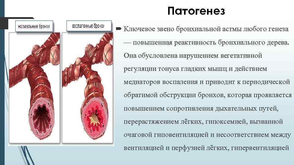 Патогенез Ключевое звено бронхиальной астмы любого генеза — повышенная реактивность бронхиального дерева. Она обусловлена