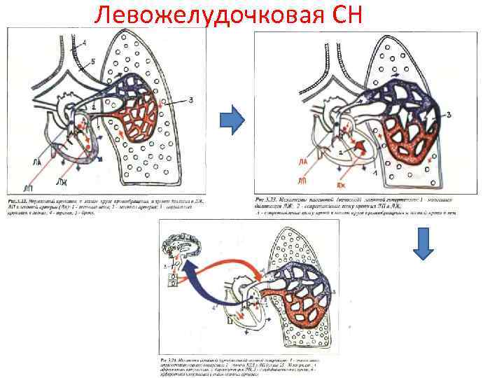 Острая правожелудочковая сердечная недостаточность презентация