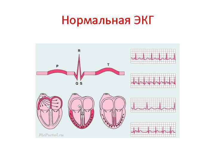 Нормальная ЭКГ 