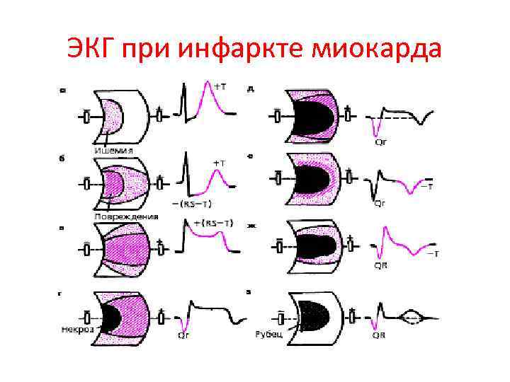 ЭКГ при инфаркте миокарда 