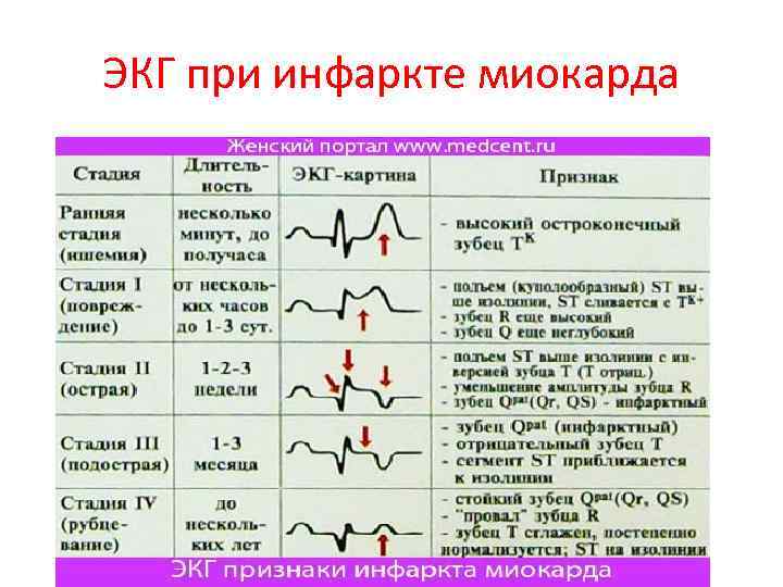 Причины инфаркта миокарда тест