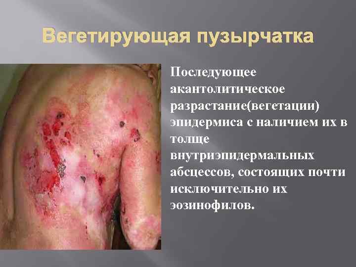 Вегетирующая пузырчатка Последующее акантолитическое разрастание(вегетации) эпидермиса с наличием их в толще внутриэпидермальных абсцессов, состоящих