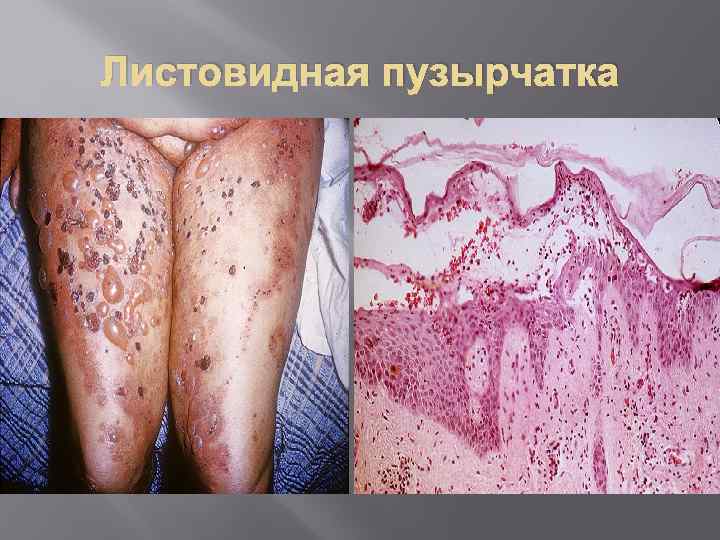 Листовидная пузырчатка 