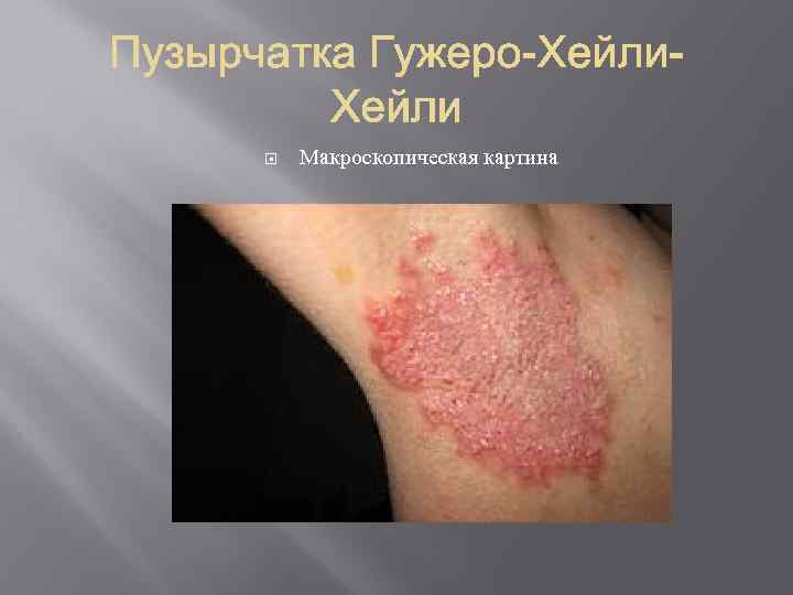  Макроскопическая картина 