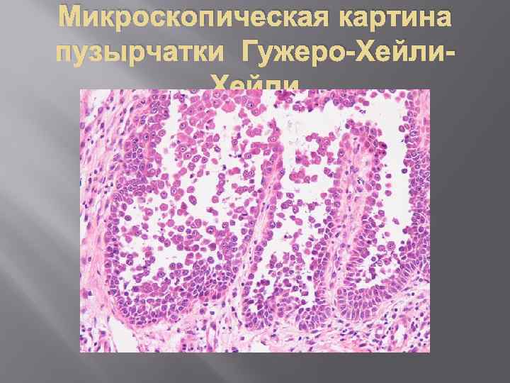 Микроскопическая картина пузырчатки Гужеро-Хейли 