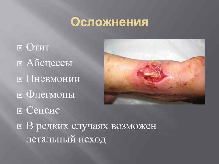 Осложнения Отит Абсцессы Пневмонии Флегмоны Сепсис В редких случаях возможен летальный исход 