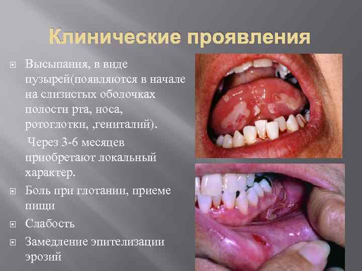 Клинические проявления Высыпания, в виде пузырей(появляются в начале на слизистых оболочках полости рта, носа,