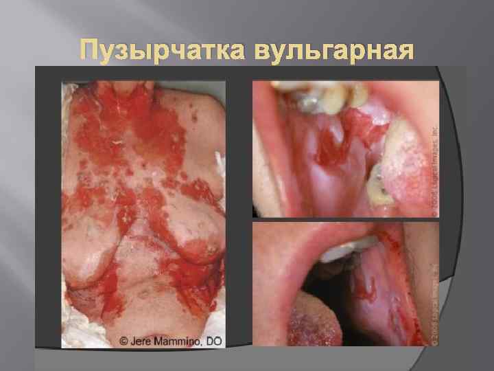 Пузырчатка вульгарная 