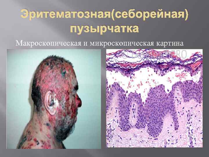 Эритематозная(себорейная) пузырчатка Макроскопическая и микроскопическая картина 
