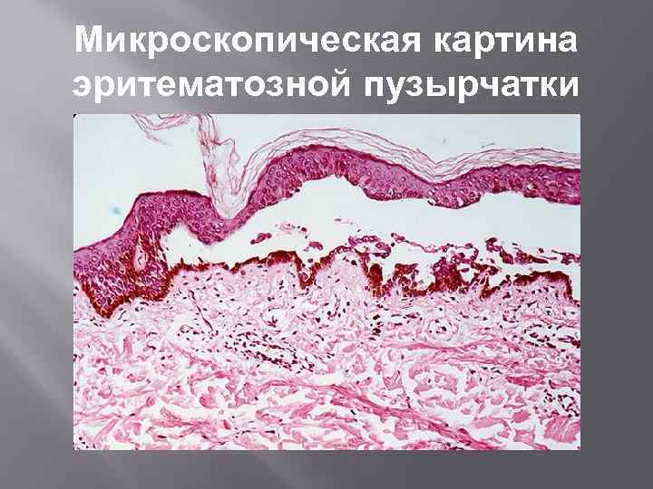 Микроскопическая картина эритематозной пузырчатки 